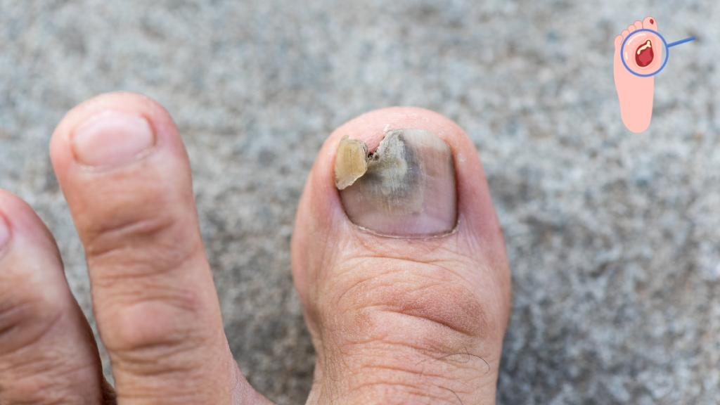 Toenail Fungus